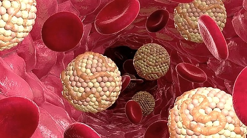 Как простая ошибка может спровоцировать атеросклероз при высоком холестерине