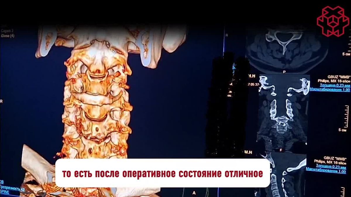 В травматолого-ортопедическом отделении ГБУЗ «Межрайонная многопрофильная больница» успешно проведена сложная операция на шейном отделе позвоночника